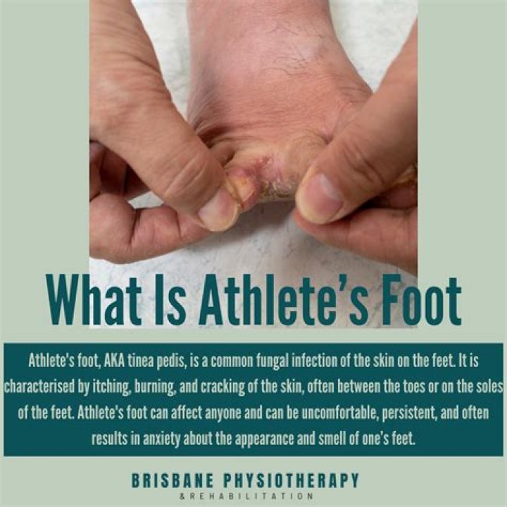 Does athlete's foot smell?